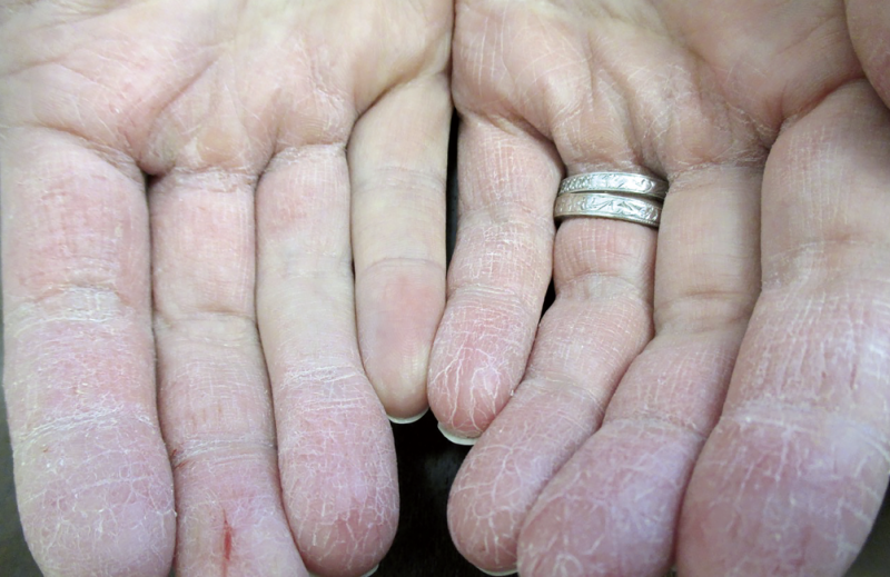 What's Causing This Woman's Itchy, Painful, Fissured Fingers And Palms?